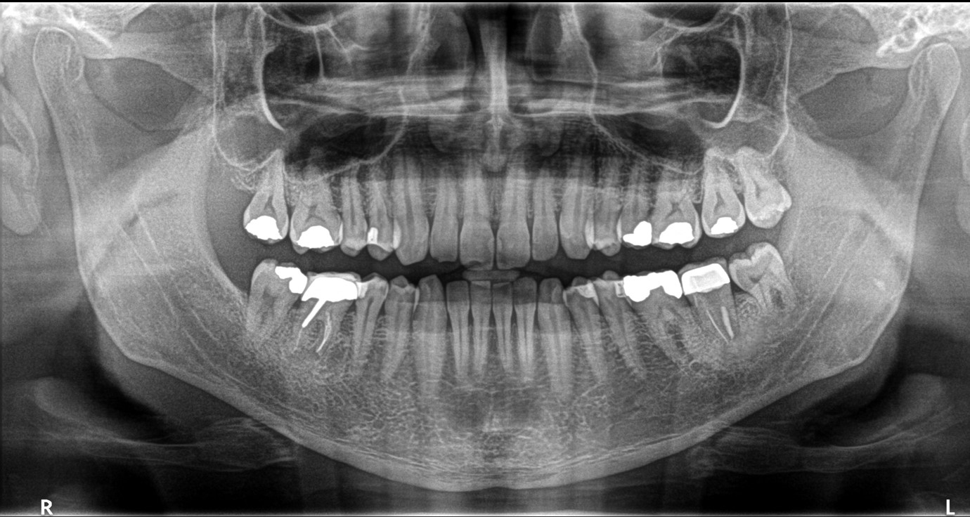 دندانپزشکی: دندان عقل