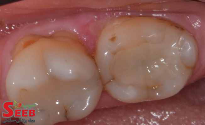 پر کردن دندان با کامپوزیت بهتر است یا آمالگام؟