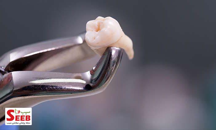 دندان عقل چیست؟ آیا باید دندان عقل را بکشیم؟