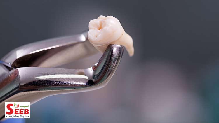 از کجا بفهمیم دندان عقل داریم