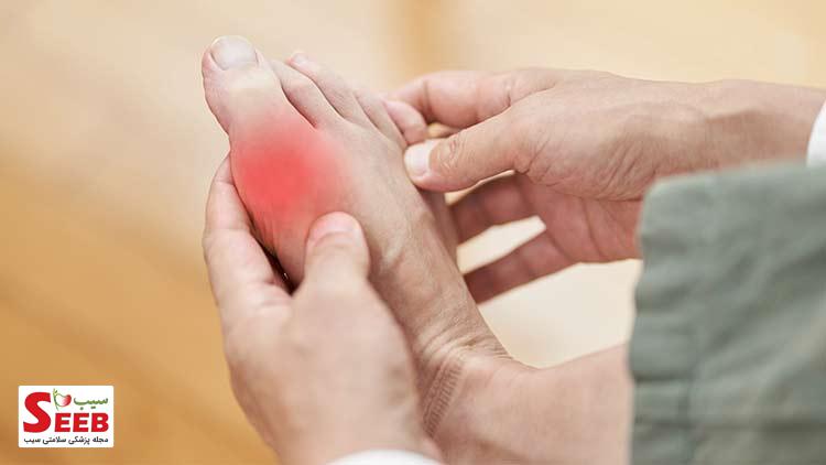بیماری نقرس چیست و چگونه درمان میشود؟ بیماری نقرس چگونه ایجاد میشود