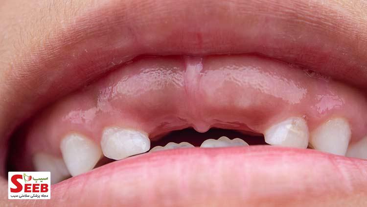 اسیب-دندان