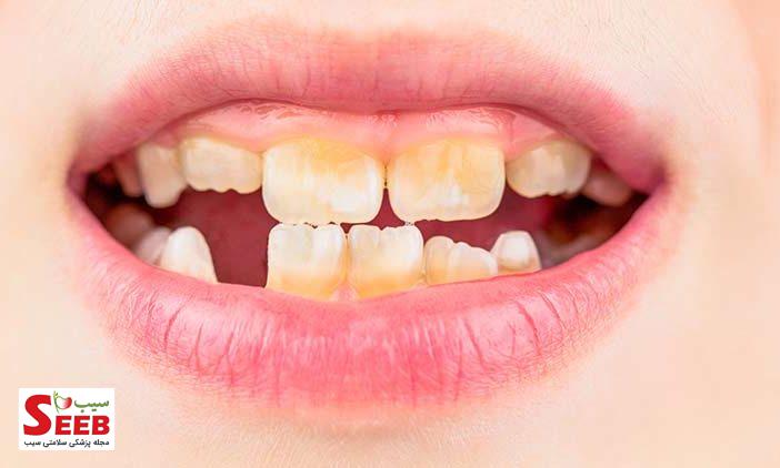آسیب‌های دندانی در کودکان