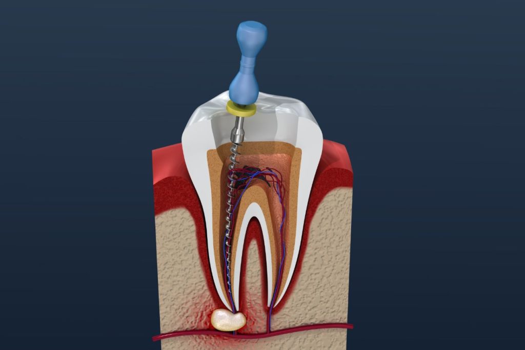 درمان ریشه دندان – Root Canal Therapy
