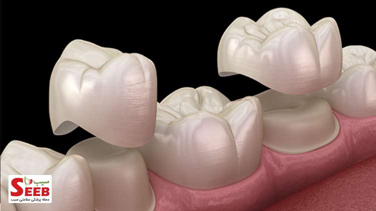 مزایا، معایب و انواع روکش دندان بهترین نوع روکش دندان