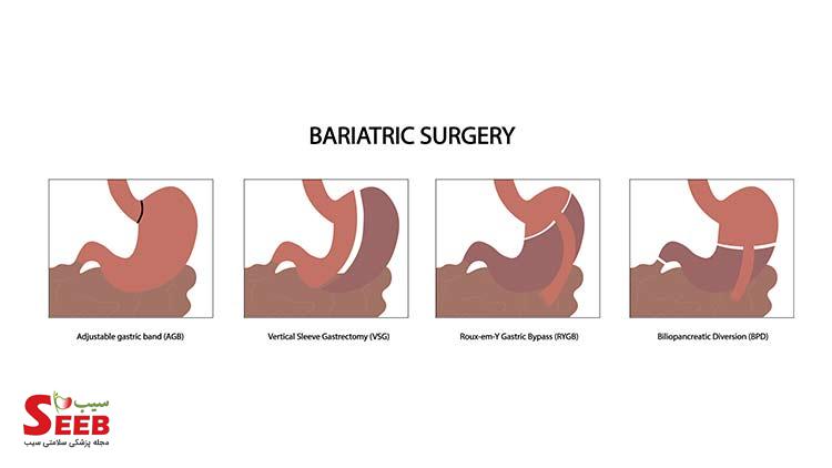bariatric surgery چیست