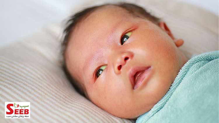 تاثیر شیر مادر بر زردی نوزاد تاثیر شیر مادر بر زردی نوزاد