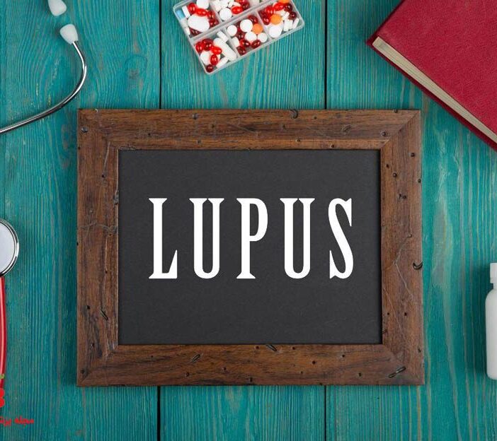 لوپوس چیست ؟ علائم و تغذیه در بیماران لوپوس چگونه باید باشد ؟