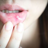 بررسی کامل علت آفت دهان و درمان خانگی آفت دهان