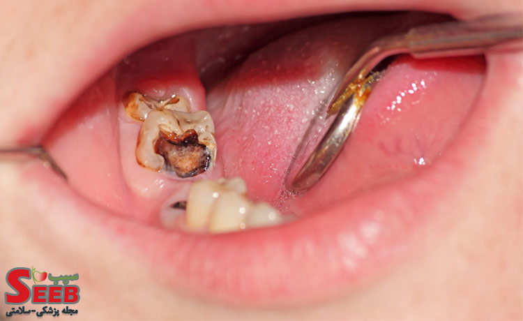 دندان چگونه پوسیده می شود