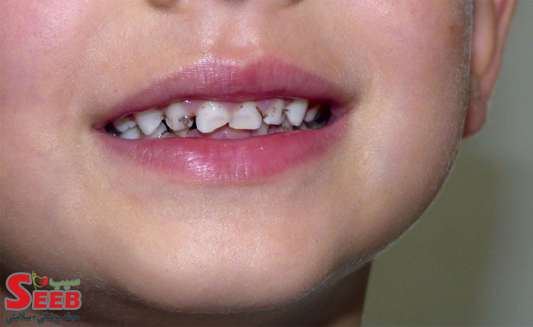 چگونه از پوسیدگی دندان جلوگیری کنیم