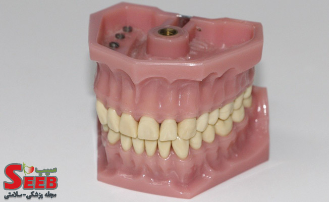 دندان قروچه یا بروکسیسم چیست و چگونه درمان می‌شود؟