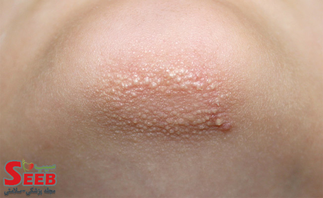اختلال پوست مرغی یا کراتوز پیلاریس چیست و چگونه درمان می‌شود؟
