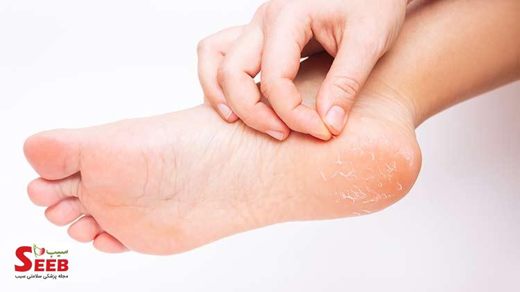پوست پوست شدن کف پا پوست پوست شدن کف پا