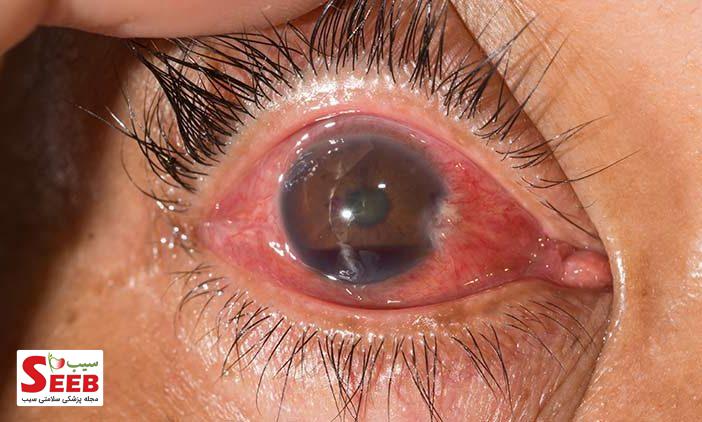 معرفی انواع عفونت های چشمی، شناسایی تا درمان
