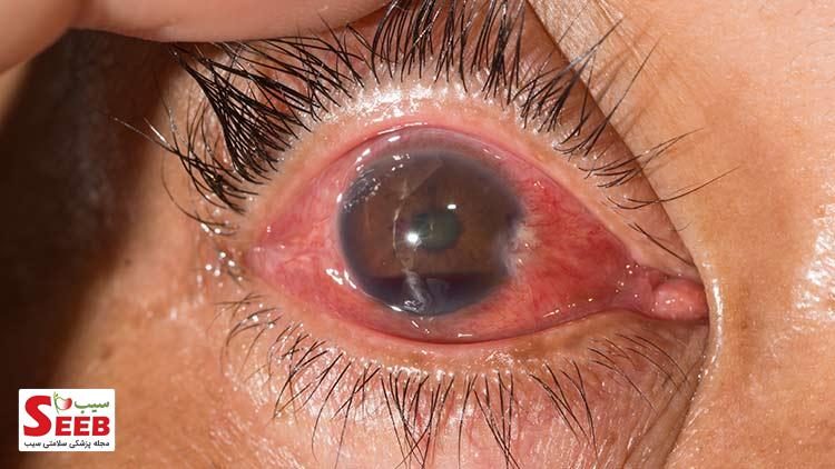 نشانه های عفونت چشمی