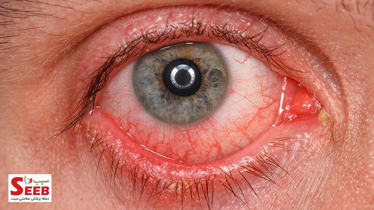 روش درمان عفونت های چشمی