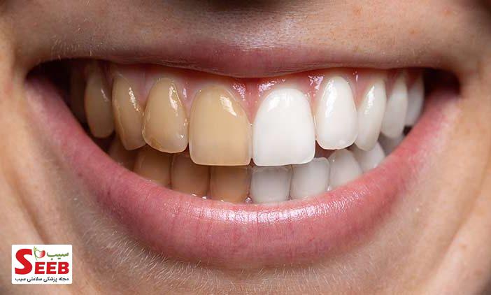 چرا دندان‌ها زرد می‌شوند؟