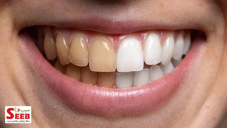 درمان زرد شدن دندان ها