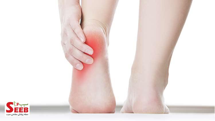 خار پاشنه پا، از علائم تا درمان علت رسوب کلسیم