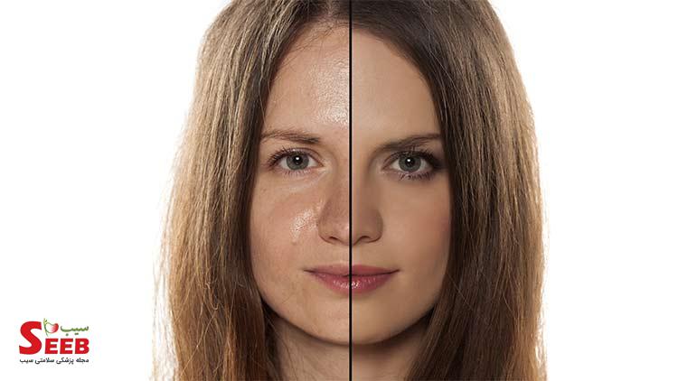 پوست چرب چیست؟ بهترین راه جلوگیری از چرب شدن پوست نشانه های پوست چرب