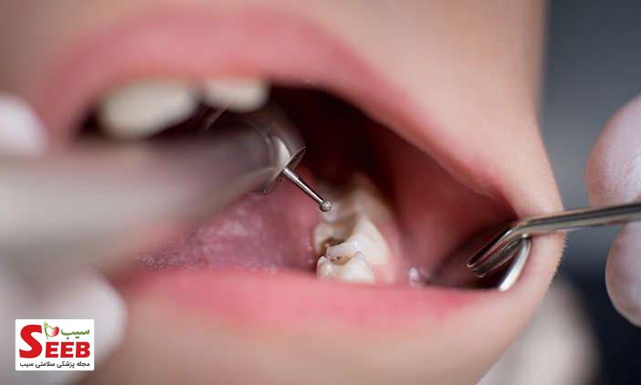 درمان ریشه دندان – عصب کشی