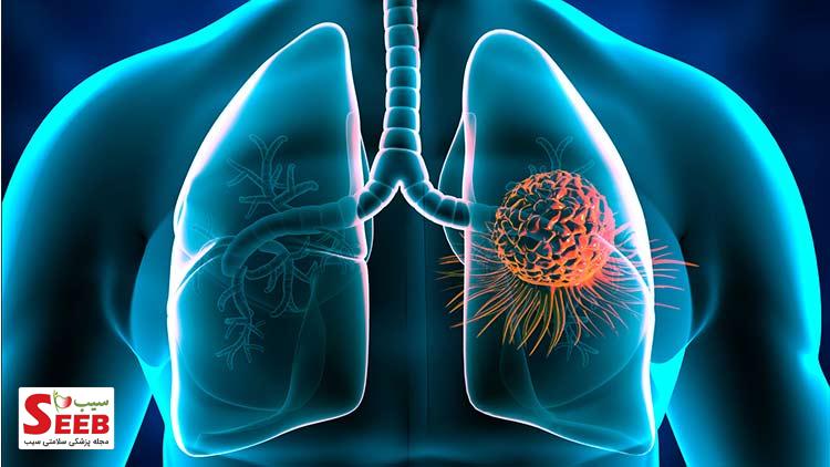 از تشخیص تا درمان سرطان ریه سرطان ریه
