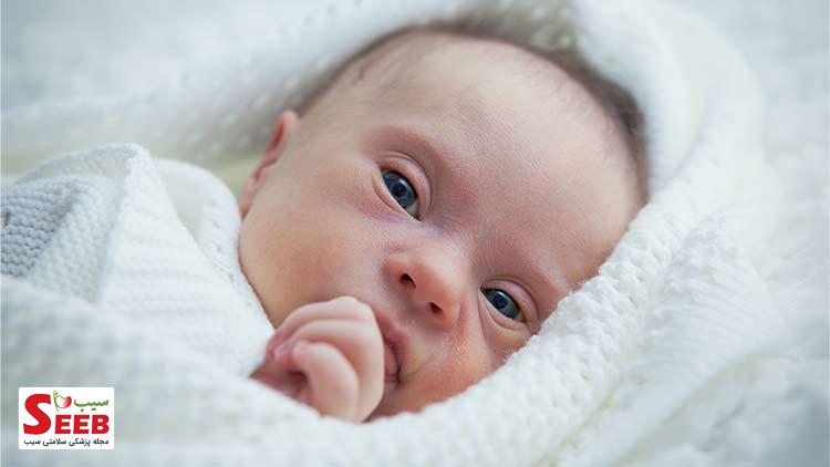 شیردهی به نوزاد سندرم داون عکس نوزاد سندرومی