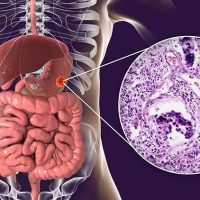 سرطان معده چیست و چگونه میتوان از آن جلوگیری کرد؟