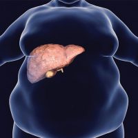 درمان کبد چرب بدون دارو