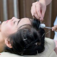 کاربرد طب سوزنی برای اعصاب