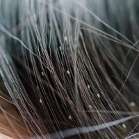 برای از بین بردن شپش چه باید کرد؟
